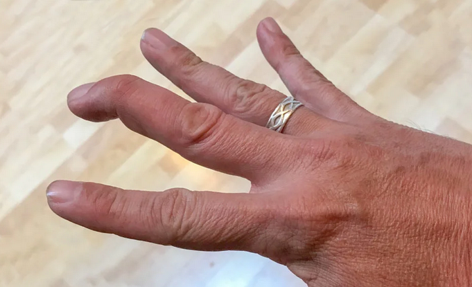 Beyzbol (Çekiç) parmağın tedavisi nasıl uygulanır?